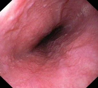 Gemeinschaftspraxis für Innere Medizin und Gastroenterologie Fieler - Potthoff in Wunstorf - Magenspiegelung Speiseröhre