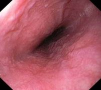 Gemeinschaftspraxis für Innere Medizin und Gastroenterologie Fieler - Potthoff in Wunstorf - Magenspiegelung Speiseröhre