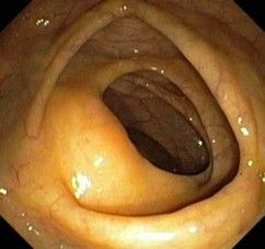 Gemeinschaftspraxis für Innere Medizin und Gastroenterologie Fieler & Potthoff in Wunstorf - Darmspiegelung