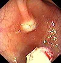 Gemeinschaftspraxis für Innere Medizin und Gastroenterologie Fieler & Potthoff in Wunstorf - Darmspiegelung Probenentnahme Polyp