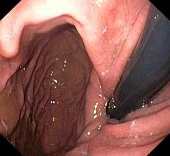 Gemeinschaftspraxis für Innere Medizin und Gastroenterologie Fieler - Potthoff in Wunstorf - Magenspiegelung Magen