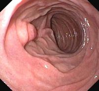 Gemeinschaftspraxis für Innere Medizin und Gastroenterologie Fieler - Potthoff in Wunstorf - Magenspiegelung Zwölffingerdarm
