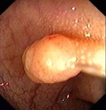Gemeinschaftspraxis für Innere Medizin und Gastroenterologie Fieler & Potthoff in Wunstorf - Darmspiegelung Polyp