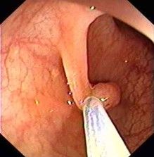Gemeinschaftspraxis für Innere Medizin und Gastroenterologie Fieler & Potthoff in Wunstorf - Darmspiegelung Abtragung Polyp
